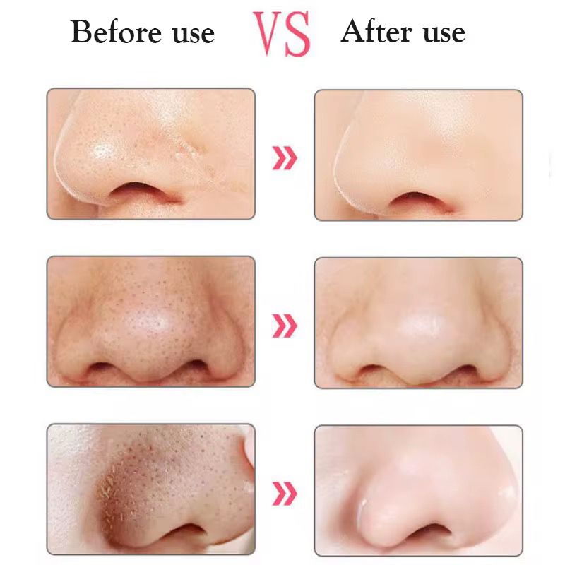 Black Heads Removal Device
